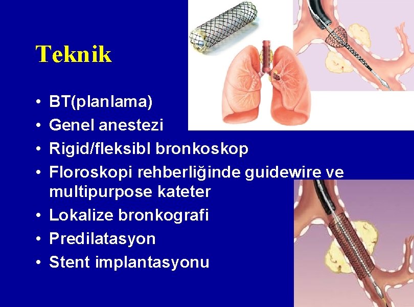 Teknik • • BT(planlama) Genel anestezi Rigid/fleksibl bronkoskop Floroskopi rehberliğinde guidewire ve multipurpose kateter