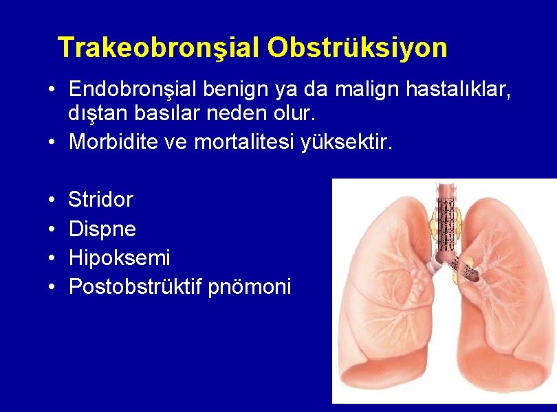 Trakeobronşial Obstrüksiyon • Endobronşial benign ya da malign hastalıklar, dıştan basılar neden olur. •