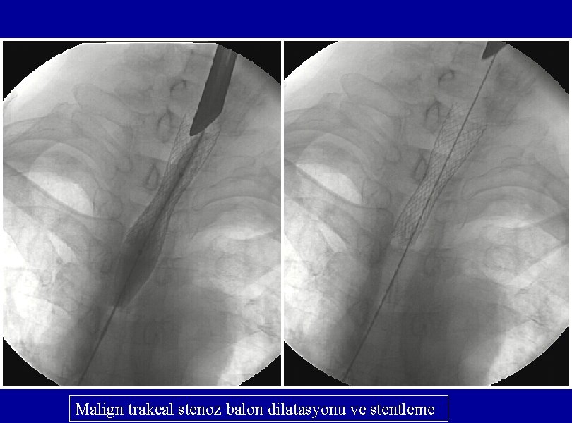 Malign trakeal stenoz balon dilatasyonu ve stentleme 