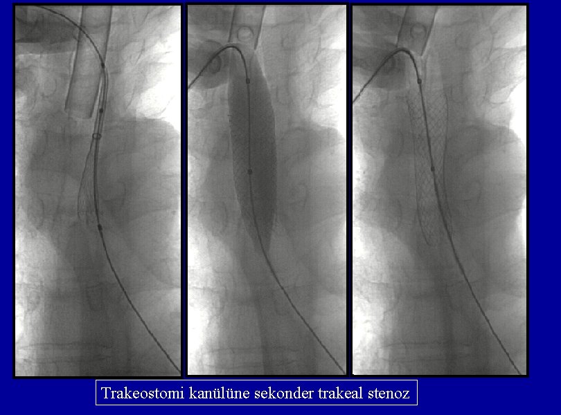 Trakeostomi kanülüne sekonder trakeal stenoz 