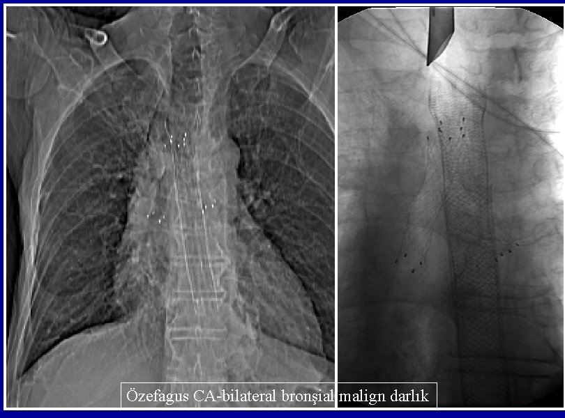 Özefagus CA-bilateral bronşial malign darlık 