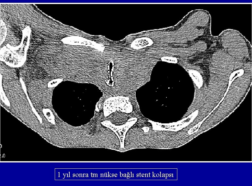 1 yıl sonra tm nükse bağlı stent kolapsı 