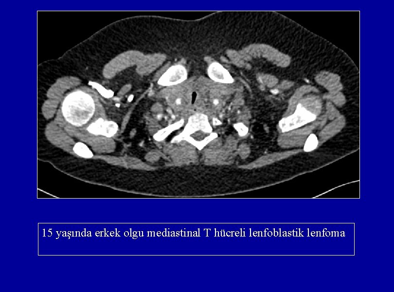 15 yaşında erkek olgu mediastinal T hücreli lenfoblastik lenfoma 