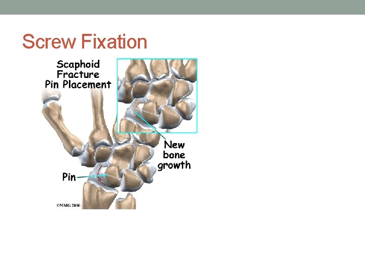 Screw Fixation 