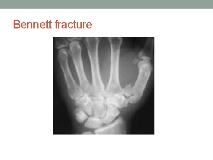 Bennett fracture 