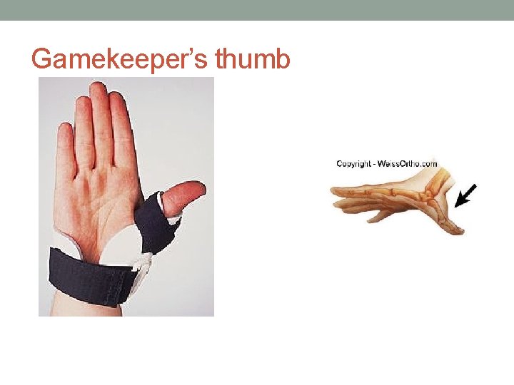Gamekeeper’s thumb 
