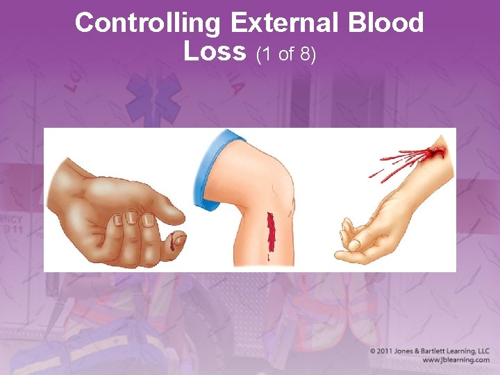 Controlling External Blood Loss (1 of 8) 