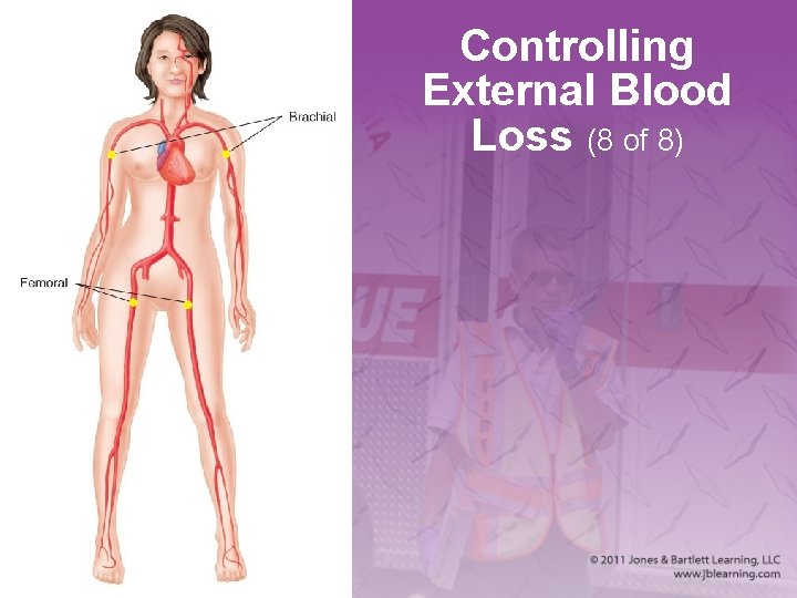 Controlling External Blood Loss (8 of 8) 