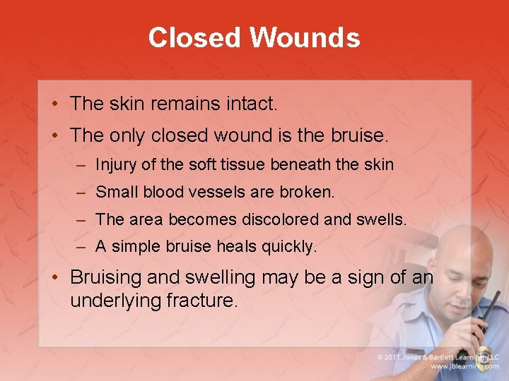 Closed Wounds • The skin remains intact. • The only closed wound is the