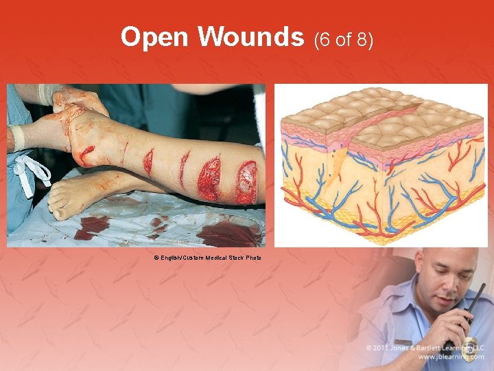 Open Wounds (6 of 8) © English/Custom Medical Stock Photo 