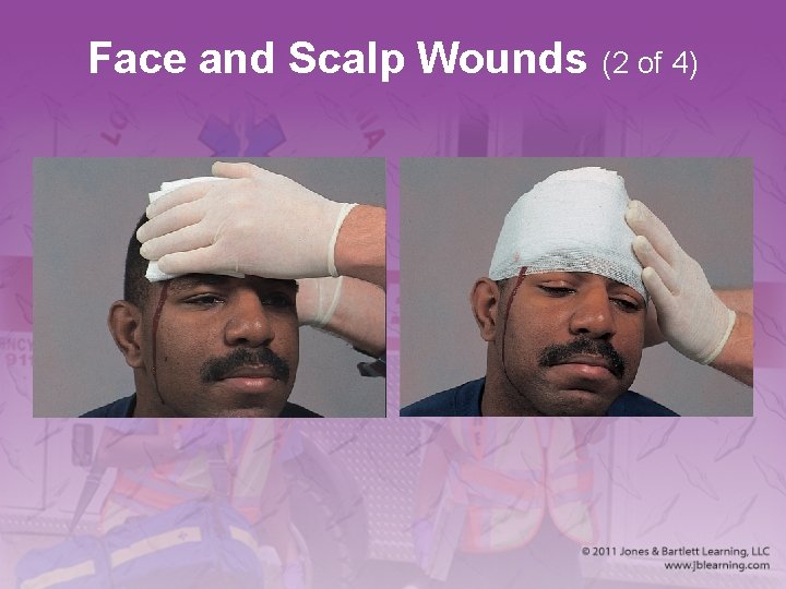 Face and Scalp Wounds (2 of 4) 