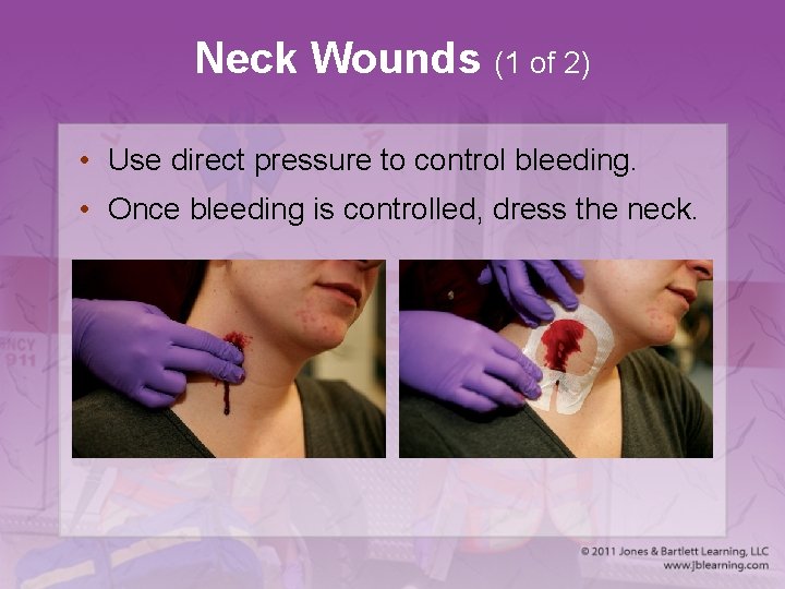 Neck Wounds (1 of 2) • Use direct pressure to control bleeding. • Once