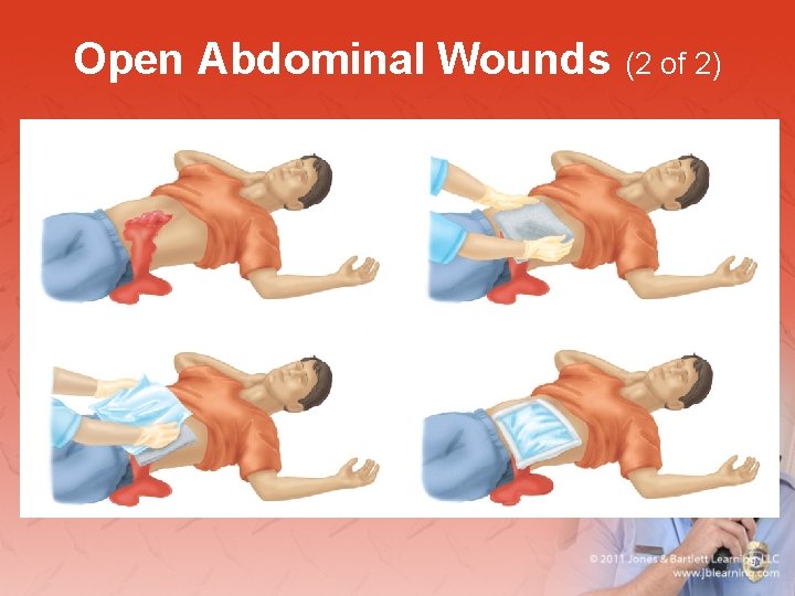 Open Abdominal Wounds (2 of 2) 