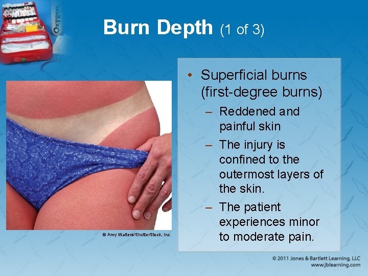 Burn Depth (1 of 3) • Superficial burns (first-degree burns) © Amy Walters/Shutter. Stock,