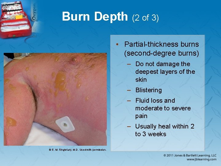 Burn Depth (2 of 3) • Partial-thickness burns (second-degree burns) – Do not damage