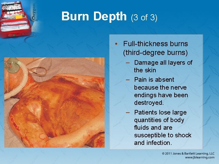 Burn Depth (3 of 3) • Full-thickness burns (third-degree burns) – Damage all layers