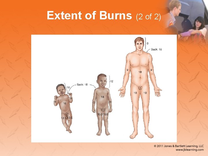 Extent of Burns (2 of 2) 