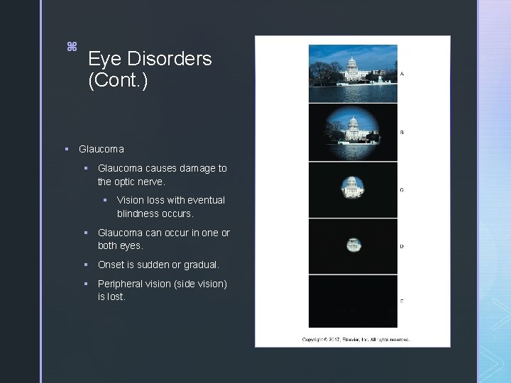 18 z z § Eye Disorders (Cont. ) Glaucoma § Glaucoma causes damage to