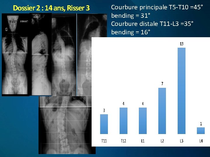 Dossier 2 : 14 ans, Risser 3 Courbure principale T 5 -T 10 =45°