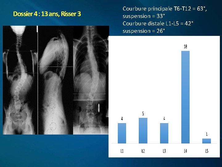 Dossier 4 : 13 ans, Risser 3 Courbure principale T 6 -T 12 =