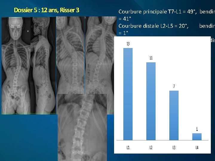Dossier 5 : 12 ans, Risser 3 Courbure principale T 7 -L 1 =