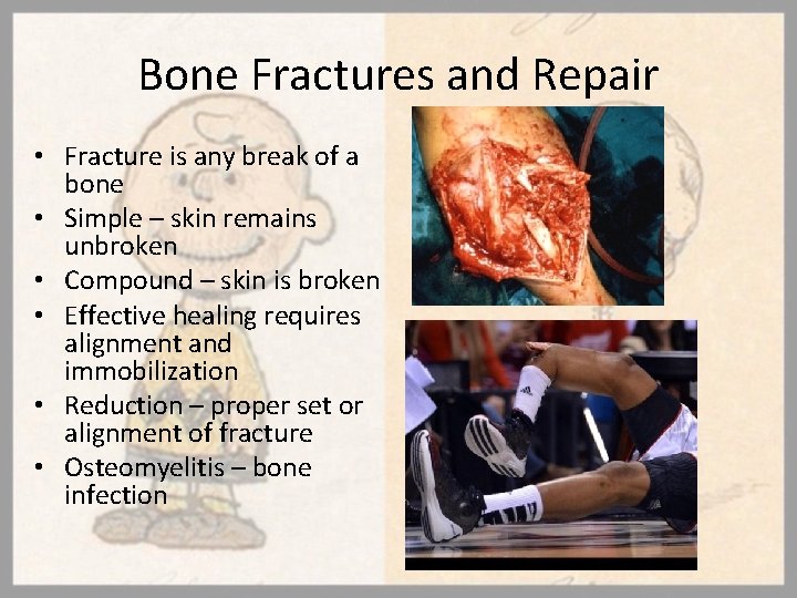 Bone Fractures and Repair • Fracture is any break of a bone • Simple