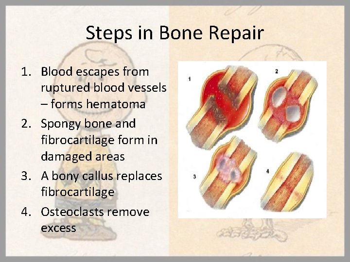 Steps in Bone Repair 1. Blood escapes from ruptured blood vessels – forms hematoma