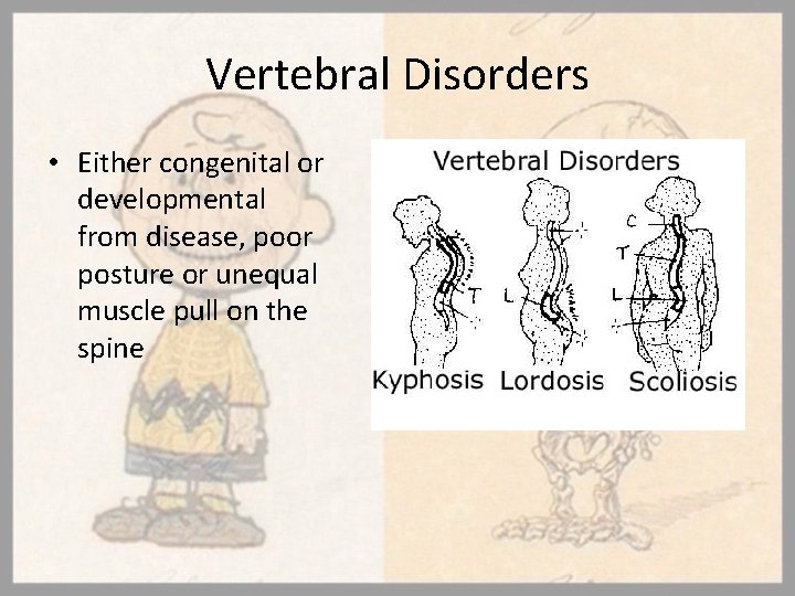 Vertebral Disorders • Either congenital or developmental from disease, poor posture or unequal muscle