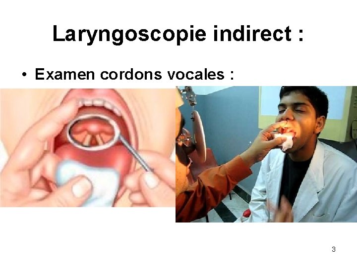 Laryngoscopie indirect : • Examen cordons vocales : 3 