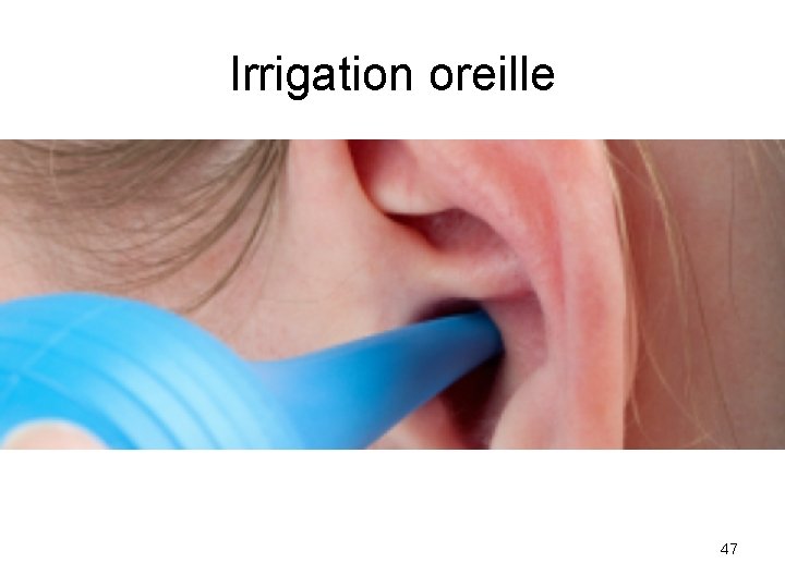 Irrigation oreille 47 