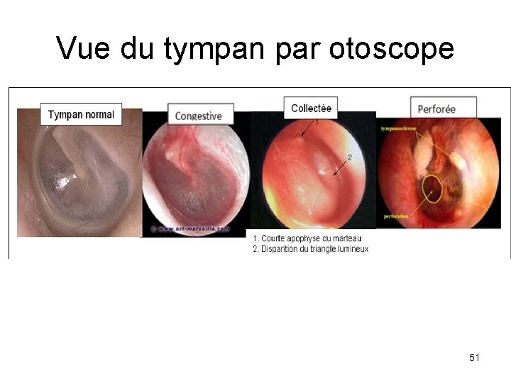 Vue du tympan par otoscope 51 