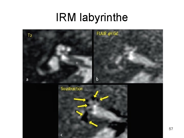 IRM labyrinthe 57 