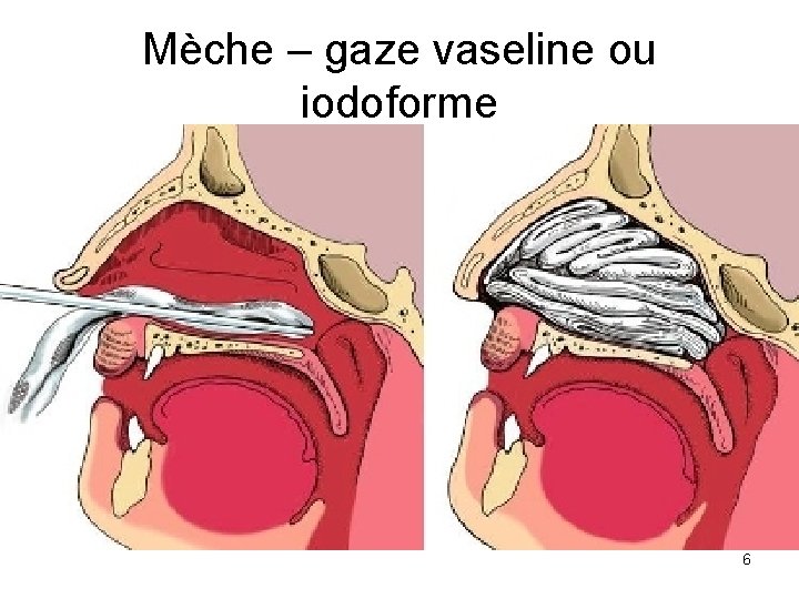 Mèche – gaze vaseline ou iodoforme 6 