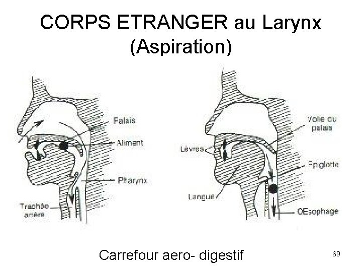 CORPS ETRANGER au Larynx (Aspiration) Carrefour aero- digestif 69 