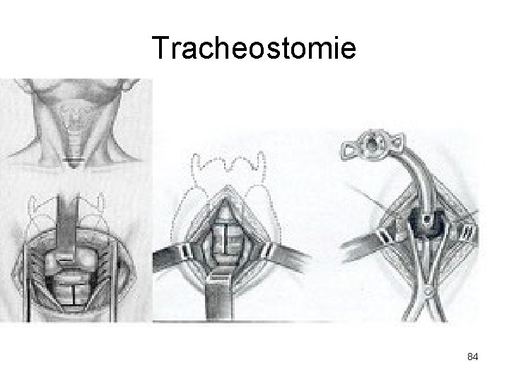 Tracheostomie 84 