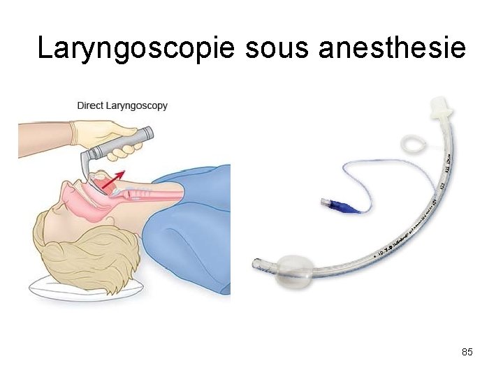 Laryngoscopie sous anesthesie 85 