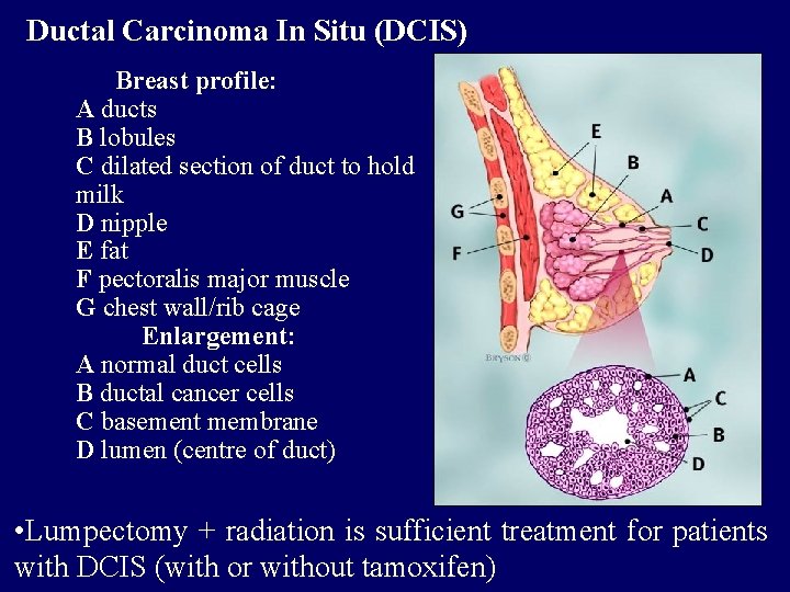 Ductal Carcinoma In Situ (DCIS) Breast profile: A ducts B lobules C dilated section