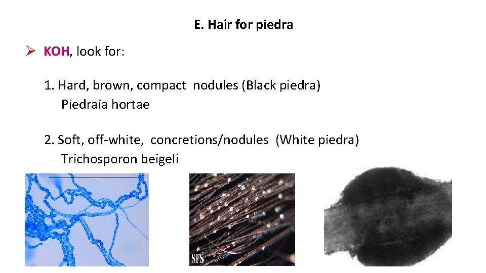 E. Hair for piedra KOH, look for: 1. Hard, brown, compact nodules (Black piedra)