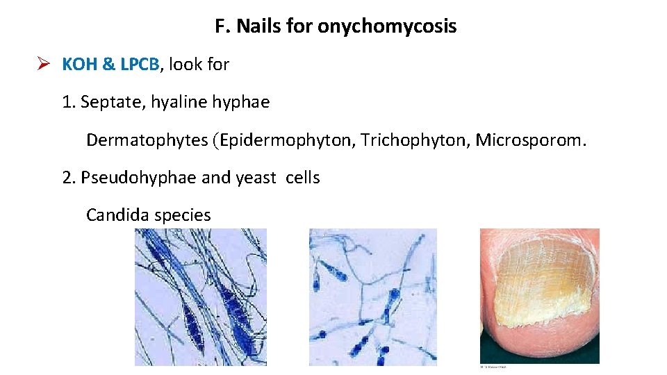 F. Nails for onychomycosis KOH & LPCB, look for 1. Septate, hyaline hyphae Dermatophytes