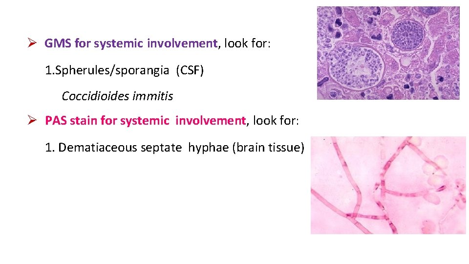  GMS for systemic involvement, look for: 1. Spherules/sporangia (CSF) Coccidioides immitis PAS stain