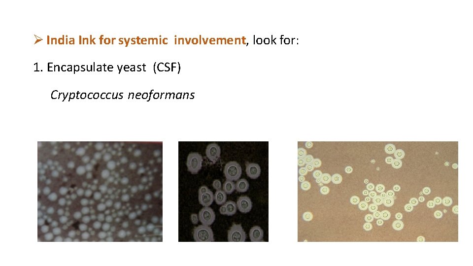  India Ink for systemic involvement, look for: 1. Encapsulate yeast (CSF) Cryptococcus neoformans