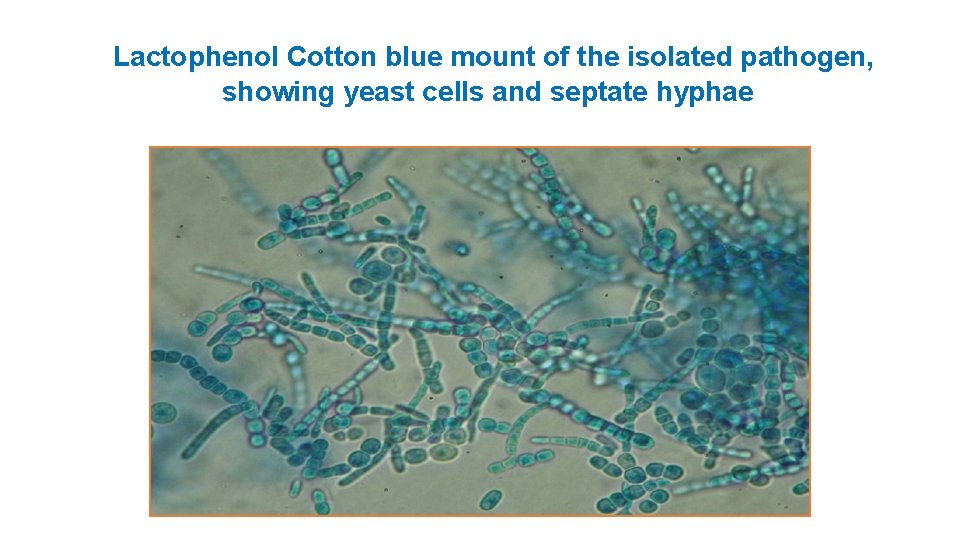 Lactophenol Cotton blue mount of the isolated pathogen, showing yeast cells and septate hyphae
