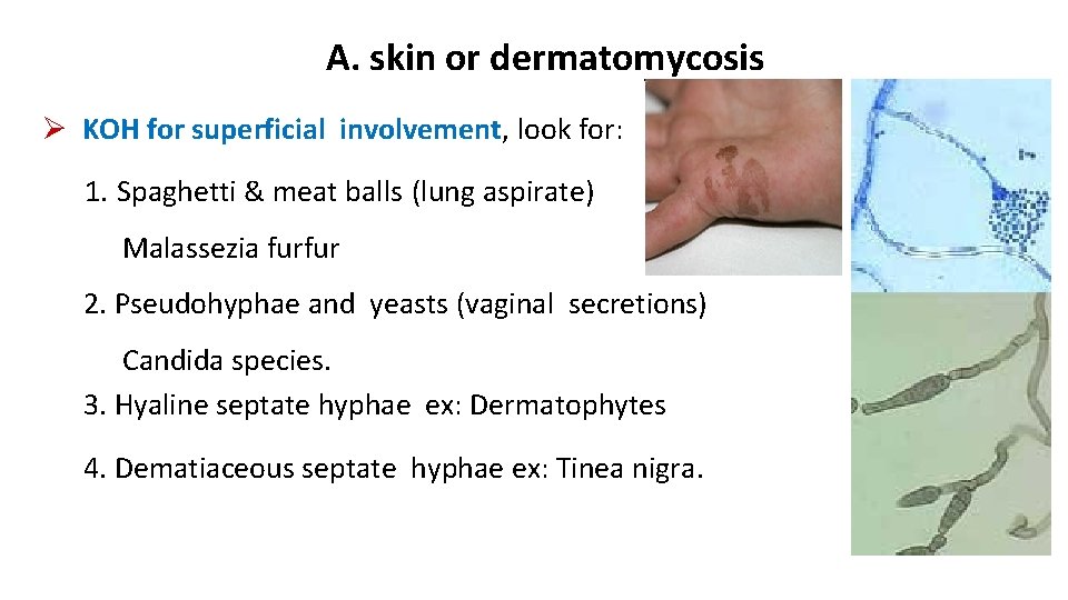 A. skin or dermatomycosis KOH for superficial involvement, look for: 1. Spaghetti & meat
