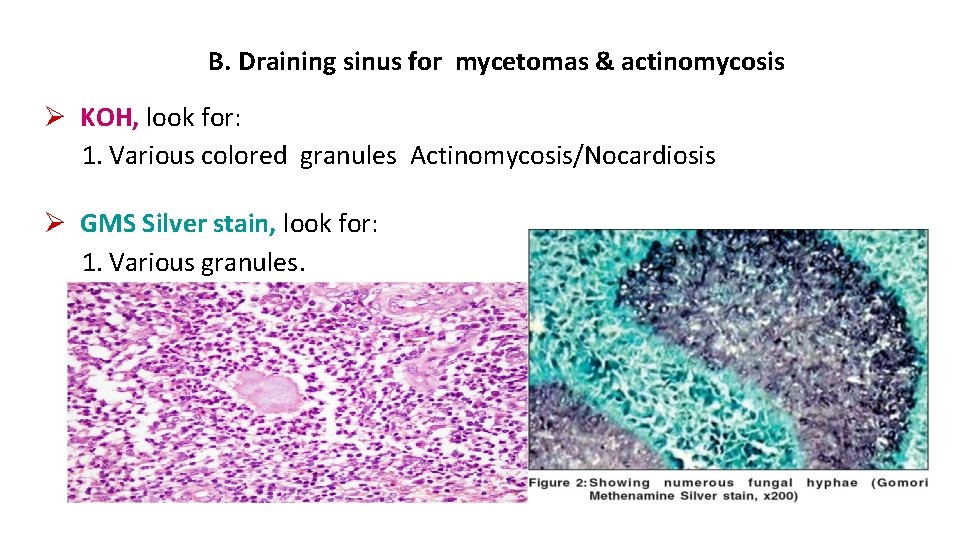 B. Draining sinus for mycetomas & actinomycosis KOH, look for: 1. Various colored granules