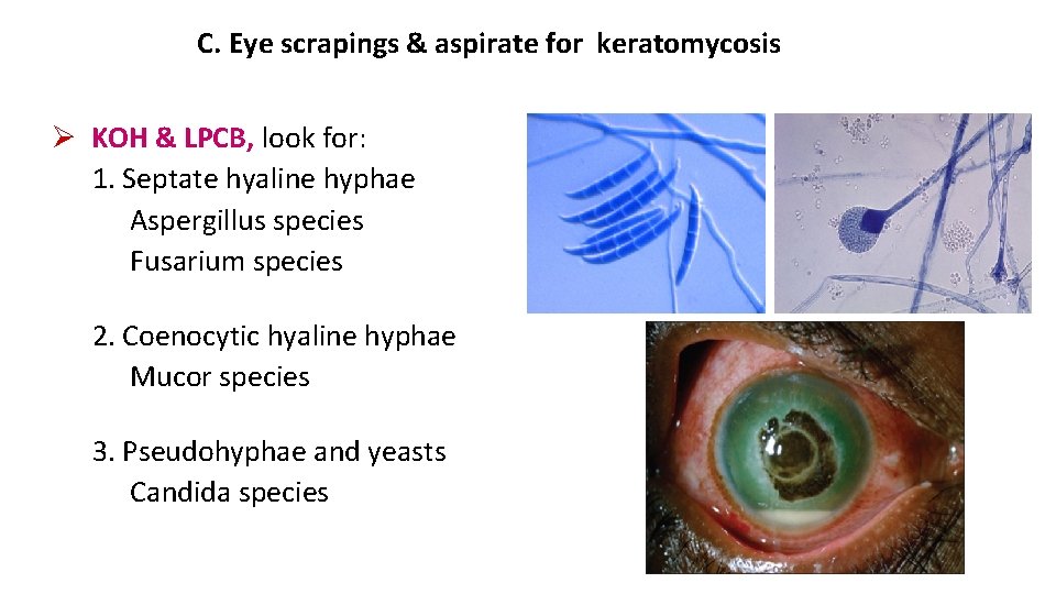 C. Eye scrapings & aspirate for keratomycosis KOH & LPCB, look for: 1. Septate