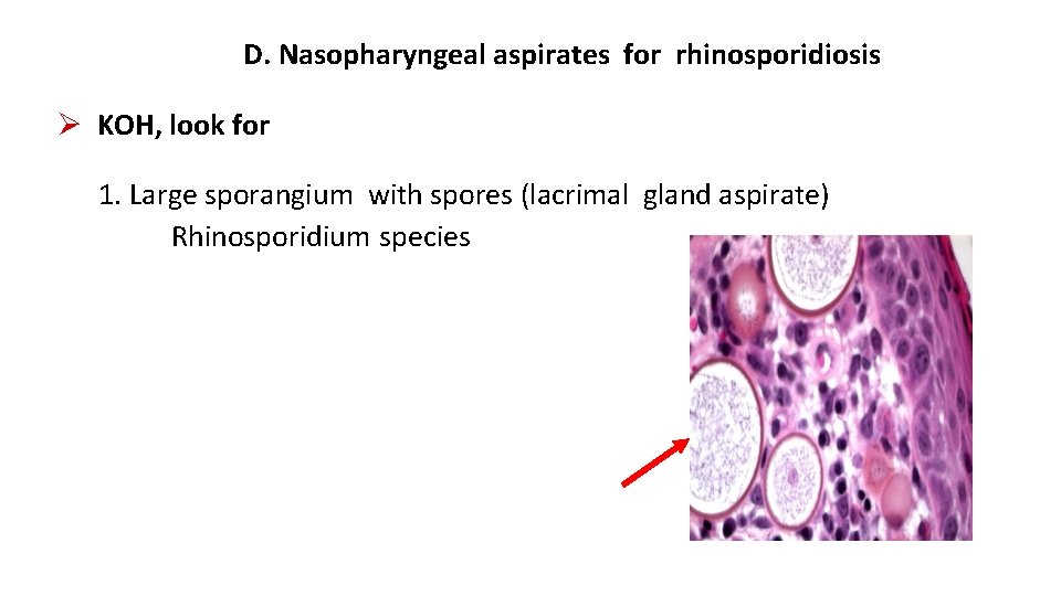D. Nasopharyngeal aspirates for rhinosporidiosis KOH, look for 1. Large sporangium with spores (lacrimal