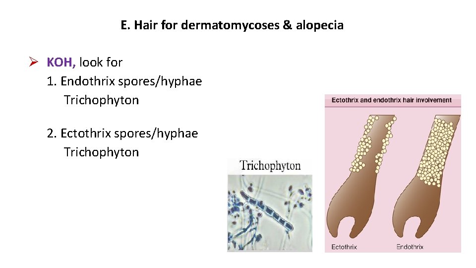 E. Hair for dermatomycoses & alopecia KOH, look for 1. Endothrix spores/hyphae Trichophyton 2.