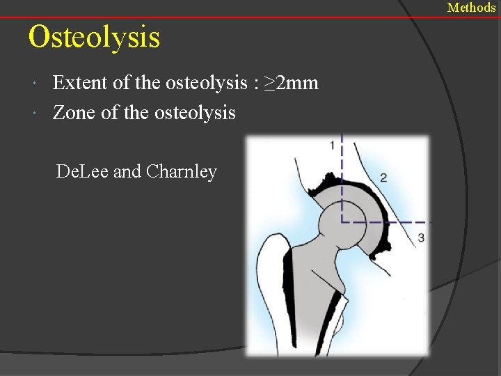 Methods Osteolysis Extent of the osteolysis : ≥ 2 mm Zone of the osteolysis