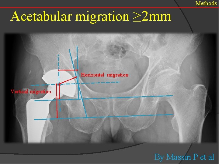 Methods Acetabular migration ≥ 2 mm Horizontal migration Vertical migration By Massin P et