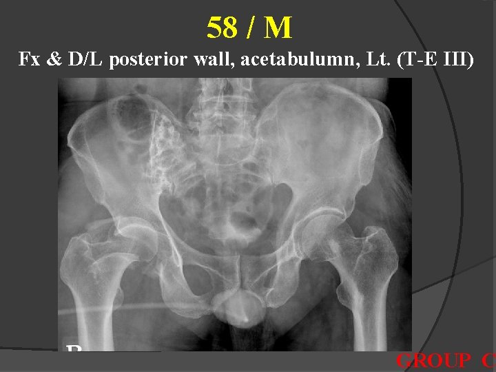 58 / M Fx & D/L posterior wall, acetabulumn, Lt. (T-E III) GROUP C